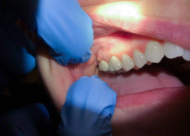 Tooth Infection Emergency Dentist in NM